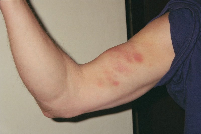 Bruises